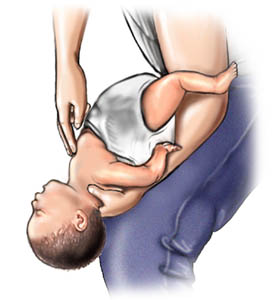 Picture of choking rescue procedure (Heimlich maneuver) with baby faceup