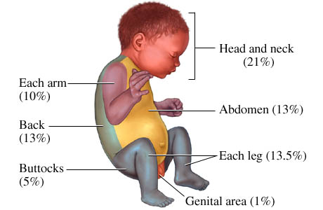 Rule of nines for babies and young children