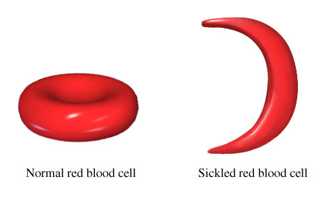 Normal blood cell and sickled blood cell