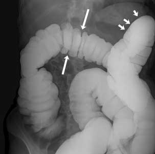 Normal colon