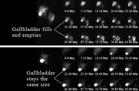 Nuclear medicine scan of gallbladders