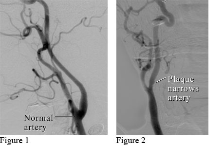 Angiograms of a normal neck artery and a neck artery narrowed by plaque 