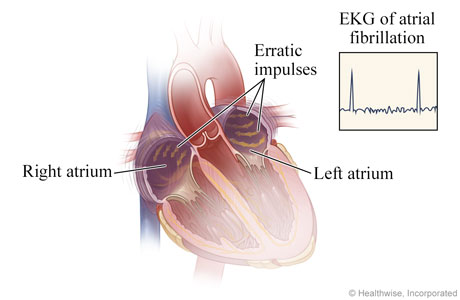 Erratic impulses in heart during atrial fibrillation and resulting  EKG