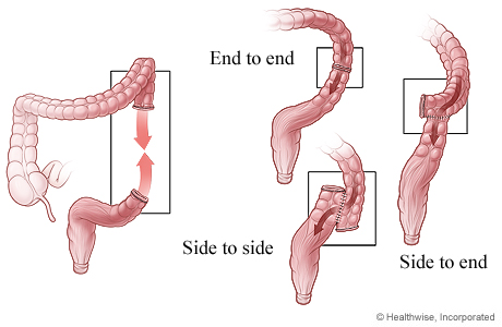 Three ways that colon ends can be reattached after surgery