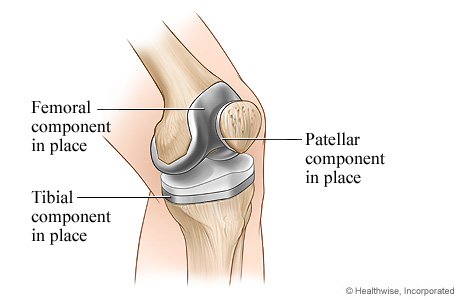 Completed knee replacement surgery