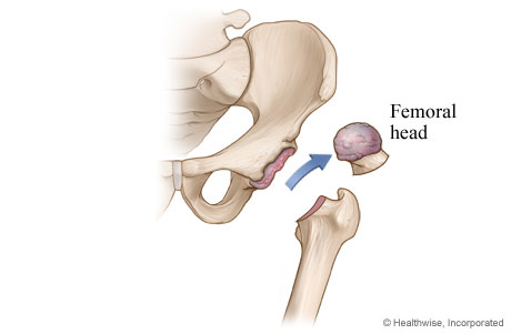 Hip replacement: Step 1 - Damaged cartilage and bone are removed