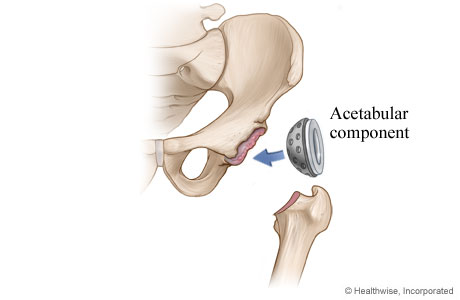 Hip replacement: Step 2 - Hip socket component is placed