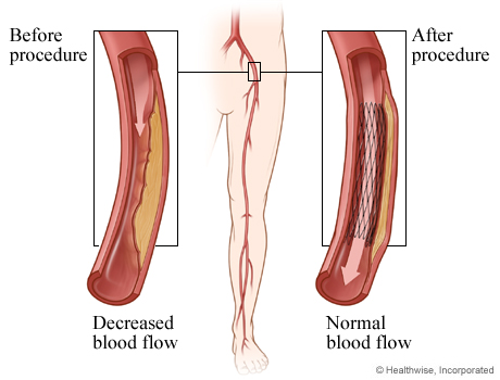 Decreased blood flow before angioplasty and normal blood flow after angioplasty 