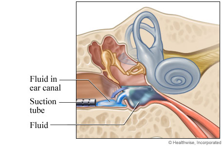 Fluid draining through the incision