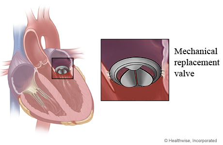 Location of mitral valve in heart and close-up of mechanical replacement valve