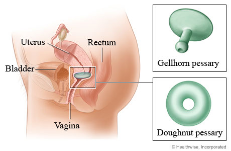 Gellhorn and doughnut pessaries