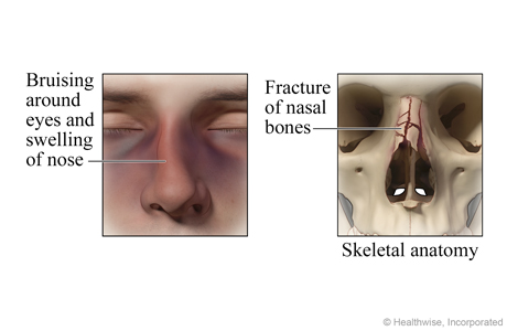 Broken nose