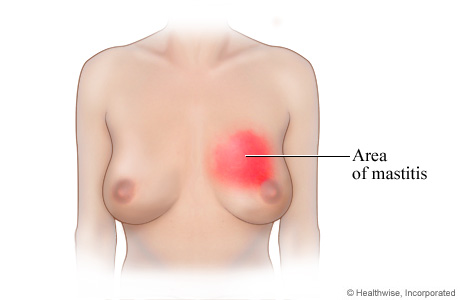 Picture of mastitis (inflammation of the breast)