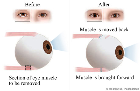 Strabismus surgery