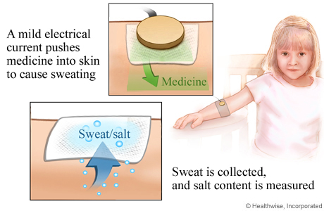 Picture of the sweat test procedure