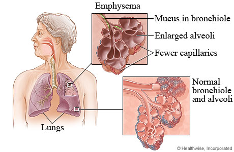 Picture of normal lung tissue and lung tissue with emphysema