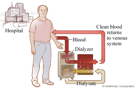 The process of hemodialysis