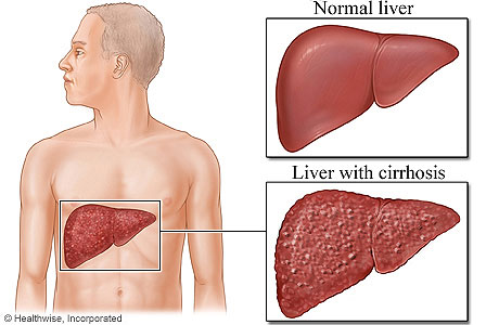 Picture comparing normal liver to liver with cirrhosis