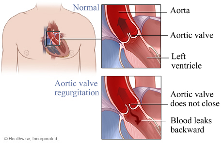 Normal aortic valve and aortic valve regurgitation