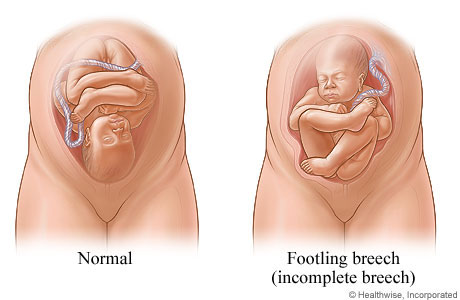 Normal position and incomplete (footling) breech position of fetus