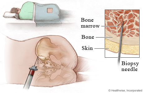 Bone marrow aspiration and biopsy