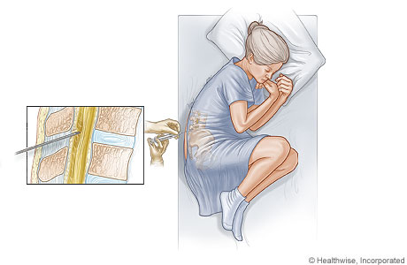 Location of a lumbar puncture