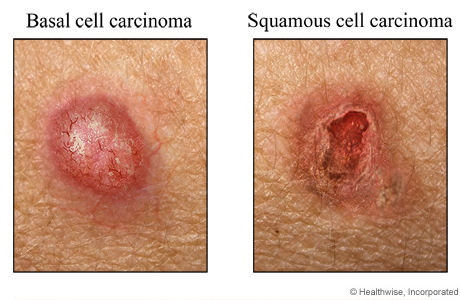 Examples of basal cell carcinoma and squamous cell carcinoma