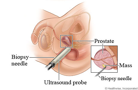 Picture of transrectal prostate biopsy