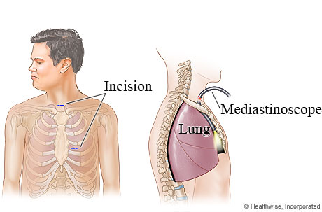 Mediastinoscopy