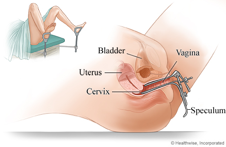 Pelvic exam using a speculum