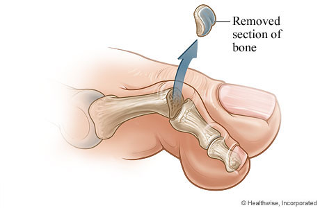 The bone section that is removed