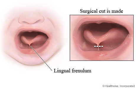 Picture of a frenotomy for tongue-tie