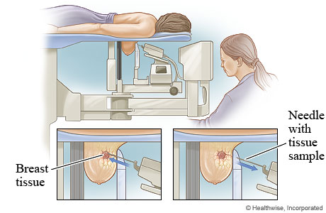 Stereotactic biopsy of the breast