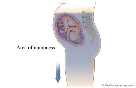 Area of numbness from epidural anesthesia