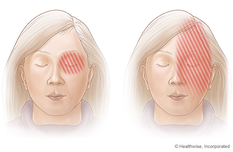 Areas of pain associated with migraine headaches