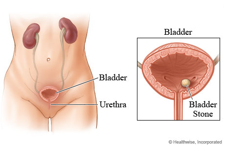 Picture of a bladder stone