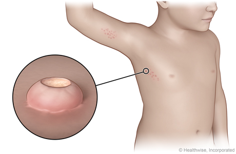 Molluscum contagiosum on the chest, with close-up of an indented bump