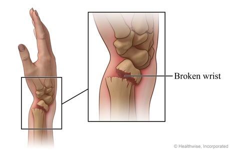 Skeletal view of  forearm and hand, with detail of broken wrist