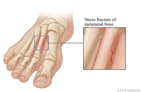 Skeletal view of foot, with detail of stress fracture in metatarsal bone