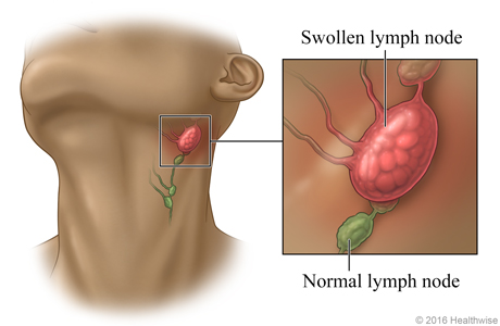 Location of lymph nodes in the neck, with close-up of swollen lymph  node and normal lymph node