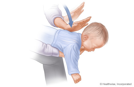 Picture of choking rescue procedure (Heimlich maneuver) with baby facedown