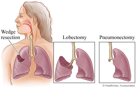 Picture of three types of lung surgery