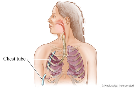 Picture of chest tube placement after lung surgery