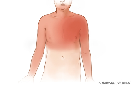 Picture of common areas where angina symptoms can be felt