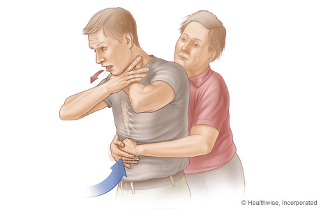 Picture of choking rescue procedure (Heimlich maneuver)