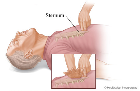 Picture of positioning the hands for chest compressions