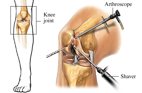 Arthroscopic procedure