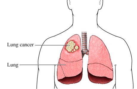 Picture of cancer cells in the upper lobe of the right lung