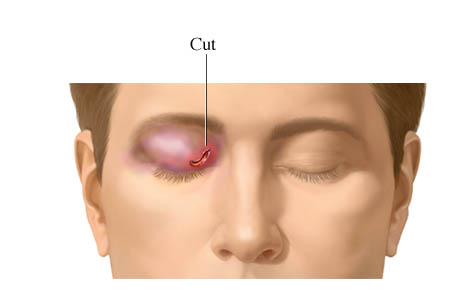 Eyelid cut (laceration)