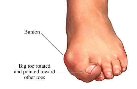 Picture of a bunion with the big toe pointed toward the other toes